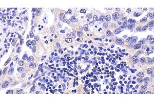 Detection of CASP9 in Human Lung cancer Tissue using Polyclonal Antibody to Caspase 9 (CASP9) (Caspase 9 抗体  (AA 331-416))