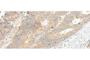 Immunohistochemistry of paraffin-embedded Human colorectal cancer tissue using GPR12 Polyclonal Antibody at dilution of 1:35(x200) (G Protein-Coupled Receptor 12 抗体)