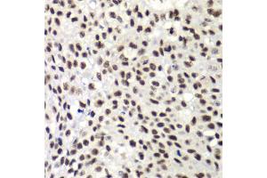 Immunohistochemistry of paraffin-embedded human lung cancer using NELFE antibody (ABIN6289947) at dilution of 1:100 (40x lens). (RDBP 抗体)