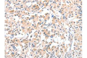 The image on the left is immunohistochemistry of paraffin-embedded Human thyroid cancer tissue using ABIN7128970(CLIP1 Antibody) at dilution 1/30, on the right is treated with fusion protein. (CLIP1 抗体)