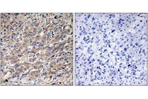 Immunohistochemistry analysis of paraffin-embedded human liver carcinoma tissue, using COX17 Antibody. (COX17 抗体  (AA 1-50))