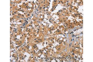 Immunohistochemistry of Human thyroid cancer using BRE Polyclonal Antibody at dilution of 1:40 (BRE 抗体)