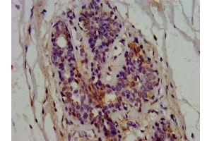 IHC image of ABIN7145566 diluted at 1:600 and staining in paraffin-embedded human breast cancer performed on a Leica BondTM system. (EPRS 抗体  (AA 1207-1399))