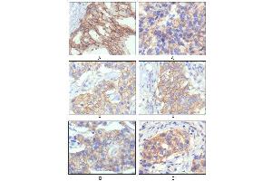 Immunohistochemical analysis of paraffin-embedded human breast intraductal carcinama tissue(A) and breast infiltrating ductal carcinama tissue(B) showing membrane localization using HER-2 mouse mAb with DAB staining. (ErbB2/Her2 抗体)