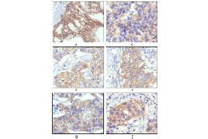 Immunohistochemical analysis of paraffin-embedded human breast intraductal carcinama tissue(A) and breast infiltrating ductal carcinama tissue(B) showing membrane localization using HER-2 mouse mAb with DAB staining. (ErbB2/Her2 抗体)