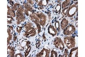 Immunohistochemical staining of paraffin-embedded Adenocarcinoma of ovary tissue using anti-AKR1A1 mouse monoclonal antibody. (AKR1A1 抗体)