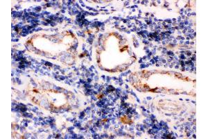 TPP1 was detected in paraffin-embedded sections of human lung cancer tissues using rabbit anti- TPP1 Antigen Affinity purified polyclonal antibody at 1 μg/mL. (TPP1 抗体  (Middle Region))