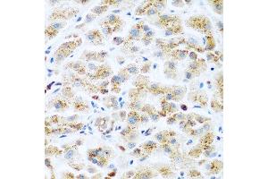 Immunohistochemistry of paraffin-embedded human liver cancer using KIAA1456 antibody at dilution of 1:200 (40x lens). (KIAA1456 抗体)