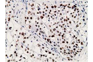 Immunohistochemical staining of paraffin-embedded Carcinoma of Human pancreas tissue using anti-TP53 mouse monoclonal antibody. (p53 抗体)