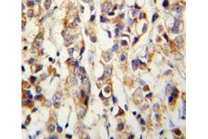 IHC analysis of FFPE human breast carcinoma with Keratin-14 antibody (KRT14 抗体  (AA 276-303))