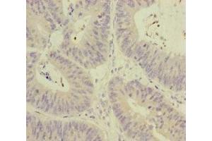 Immunohistochemistry of paraffin-embedded human colon cancer using ABIN7159631 at dilution of 1:100 (MCCC1 抗体  (AA 526-725))