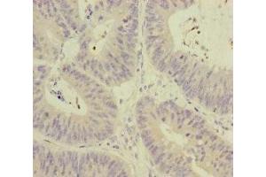 Immunohistochemistry of paraffin-embedded human colon cancer using ABIN7159631 at dilution of 1:100