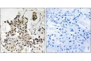 Immunohistochemistry analysis of paraffin-embedded human breast carcinoma tissue, using HP1 gamma (Ab-93) Antibody. (CBX3 抗体  (AA 59-108))