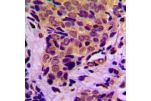 Immunohistochemical analysis of 4EBP1 (pT37) staining in human breast cancer formalin fixed paraffin embedded tissue section.