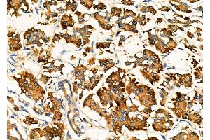 ABIN6259760 and ABIN6276996 at 1/100 staining Human pancreatic cancer and adjacent nomal tissues by IHC-P.