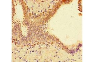 Immunohistochemistry of paraffin-embedded human prostate cancer using ABIN7172704 at dilution of 1:100 (SUPT3H/SPT3 抗体  (AA 1-328))