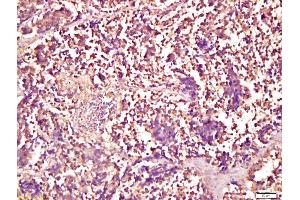 Formalin-fixed and paraffin embedded human lung carcinoma labeled with Anti-Smad1 Polyclonal Antibody, Unconjugated (ABIN732158) at 1:200 followed by conjugation to the secondary antibody and DAB staining (Smad1/5 抗体  (AA 361-465))