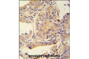 UBA52 antibody immunohistochemistry analysis in formalin fixed and paraffin embedded human prostate carcinoma followed by peroxidase conjugation of the secondary antibody and DAB staining. (UBA52 抗体  (C-Term))