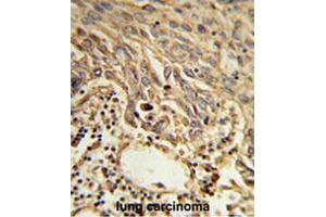 Formalin-fixed and paraffin-embedded human lung carcinoma reacted with EIF4A2 Antibody (C-term), which was peroxidase-conjugated to the secondary antibody, followed by DAB staining. (EIF4A2 抗体  (C-Term))