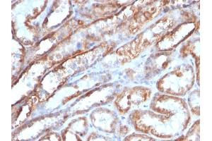Formalin-fixed, paraffin-embedded human Renal Cell Carcinoma stained with Mitochondria Monoclonal Antibody (MTC719) (Mitochondrial Marker 抗体)