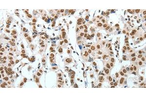 Immunohistochemistry of paraffin-embedded Human breast cancer using BNIP1 Polyclonal Antibody at dilution of 1:60 (BNIP1 抗体)