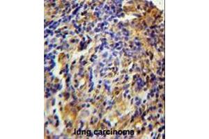 CK073 Antibody (N-term) immunohistochemistry analysis in formalin fixed and paraffin embedded human lung carcinoma followed by peroxidase conjugation of the secondary antibody and DAB staining.