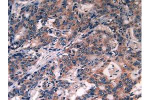 IHC-P analysis of Human Rectum Cancer Tissue, with DAB staining. (PDGFRA 抗体  (AA 170-387))