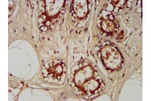 IHC image of ABIN7172365 diluted at 1:400 and staining in paraffin-embedded human breast cancer performed on a Leica BondTM system. (TRAPPC6A 抗体  (AA 1-173))