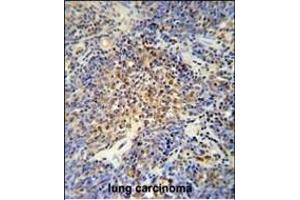 OTUD4 antibody (N-term) (ABIN652177 and ABIN2840579) immunohistochemistry analysis in formalin fixed and paraffin embedded human lung carcinoma followed by peroxidase conjugation of the secondary antibody and DAB staining. (OTUD4 抗体  (N-Term))