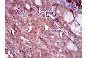 Immunohistochemical analysis of paraffin-embedded cervical cancer tissues using EGFR mutant mouse mAb with DAB staining. (EGFR Mutant (AA 693-893) 抗体)