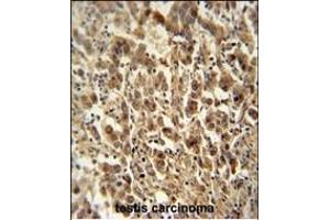 DIS3 antibody (Center) (ABIN654155 and ABIN2844022) immunohistochemistry analysis in formalin fixed and paraffin embedded human testis carcinoma followed by peroxidase conjugation of the secondary antibody and DAB staining. (DIS3 抗体  (AA 295-323))