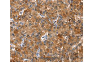 Immunohistochemistry of Human thyroid cancer using NOD2 Polyclonal Antibody at dilution of 1:40