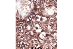 Formalin-fixed and paraffin-embedded human cancer tissue reacted with the primary antibody, which was peroxidase-conjugated to the secondary antibody, followed by DAB staining. (LRP8 抗体  (C-Term))