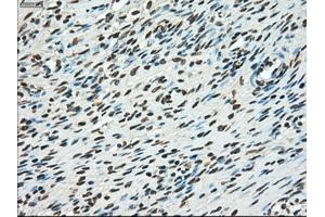 Immunohistochemical staining of paraffin-embedded Adenocarcinoma of breast tissue using anti-TYRO3 mouse monoclonal antibody. (TYRO3 抗体)