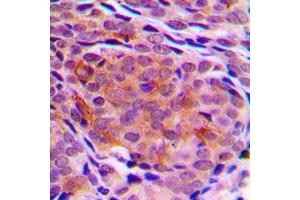 Immunohistochemical analysis of TCTP staining in human breast cancer formalin fixed paraffin embedded tissue section. (TPT1 抗体  (Center))