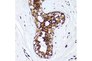 Immunohistochemistry of paraffin-embedded Human breast cancer using HSD17B7 Rabbit pAb (ABIN7267812) at dilution of 1:100 (40x lens).