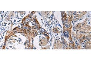Immunohistochemistry of paraffin-embedded Human esophagus cancer tissue using RITA1 Polyclonal Antibody at dilution of 1:60(x200) (RITA1 抗体)