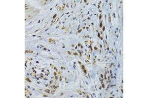 Immunohistochemistry of paraffin-embedded human gastric cancer using GABPB1 Antibody (ABIN2562720) at dilution of 1:100 (40x lens). (GABPB1 抗体)