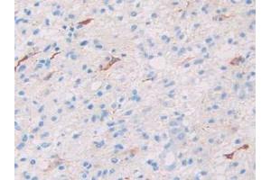 IHC-P analysis of Human Glioma Tissue, with DAB staining. (SLIT1 抗体  (AA 647-835))