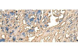 Immunohistochemistry of paraffin-embedded Human lung cancer tissue using CELA1 Polyclonal Antibody at dilution of 1:70(x200) (CELA1 抗体)