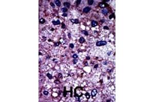 Formalin-fixed and paraffin-embedded human cancer tissue reacted with the primary antibody, which was peroxidase-conjugated to the secondary antibody, followed by DAB staining. (PFKM 抗体  (N-Term))
