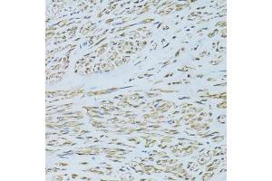 Immunohistochemistry of paraffin-embedded human uterine cancer using SLC40A1 antibody (ABIN6292414) at dilution of 1:100 (40x lens). (SLC40A1 抗体)