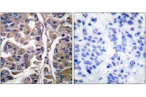 Immunohistochemistry analysis of paraffin-embedded human breast carcinoma tissue, using Keratin 20 Antibody. (KRT20 抗体  (AA 375-424))