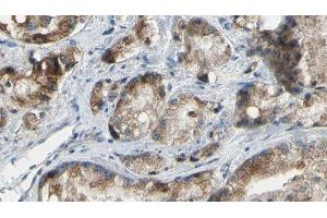 ABIN6277337 at 1/100 staining Human prostate tissue by IHC-P. (PAK4 抗体  (Internal Region))