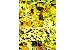 Formalin-fixed and paraffin-embedded human cancer tissue reacted with the primary antibody, which was peroxidase-conjugated to the secondary antibody, followed by AEC staining. (PKC delta 抗体  (N-Term))