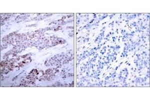 Immunohistochemistry analysis of paraffin-embedded human breast carcinoma, using ATF4 (Phospho-Ser245) Antibody. (ATF4 抗体  (pSer245))