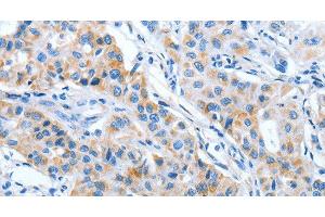 Immunohistochemistry of paraffin-embedded Human lung cancer using IMMT Polyclonal Antibody at dilution of 1:70 (IMMT 抗体)
