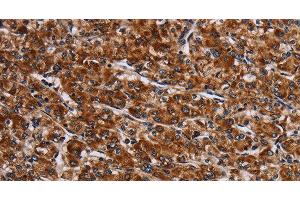 Immunohistochemistry of paraffin-embedded Human prostate cancer tissue using LRRC15 Polyclonal Antibody at dilution 1:60 (LRRC15 抗体)