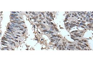 Immunohistochemistry of paraffin-embedded Human colorectal cancer tissue using HELLS Polyclonal Antibody at dilution of 1:30(x200) (HELLS 抗体)