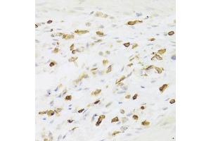 Immunohistochemistry of paraffin-embedded human gastric cancer using LSP1 Antibody (ABIN5973271) at dilution of 1/100 (40x lens). (LSP1 抗体)